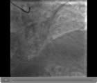 Coronary Angiogram 2 - Demonstrating severe coronary artery disease.