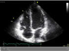 Echocardiogram 1 - This is an ultrasound image showing all four chambers of the heart.