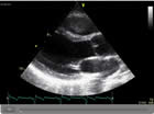Echocardiogram 2 - This ultrasound image shows the aortic and mitral valves as well as the main heart chambers.